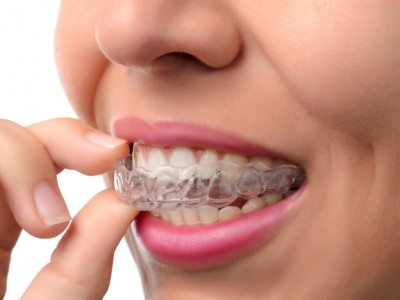 Invisalign: La manera más discreta y cómoda de alinear tus dientes 