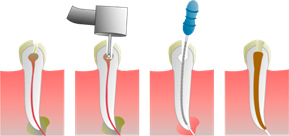 Endodoncia
