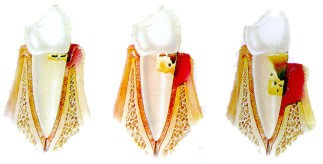 Periodoncia