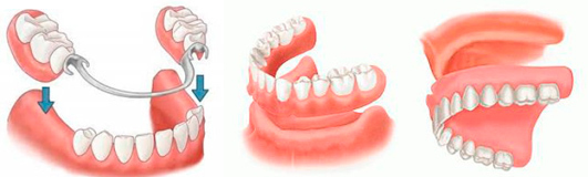 Prótesis dental